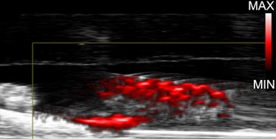 Researchers were able to visualize biofilms in teeth treated with dextran-coated gold nanoparticles using photoacoustic imaging.