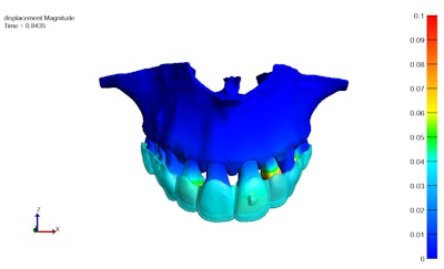 A digital twin of a patient's jaw created through the integration of AI solutions and computational modeling, enabling precise simulation of anticipated teeth movements under specific conditions. The color map visually represents the extent and direction of teeth movement, with warmer colors indicating higher teeth movements. Image and caption courtesy of the University of Copenhagen Department of Computer Science.
