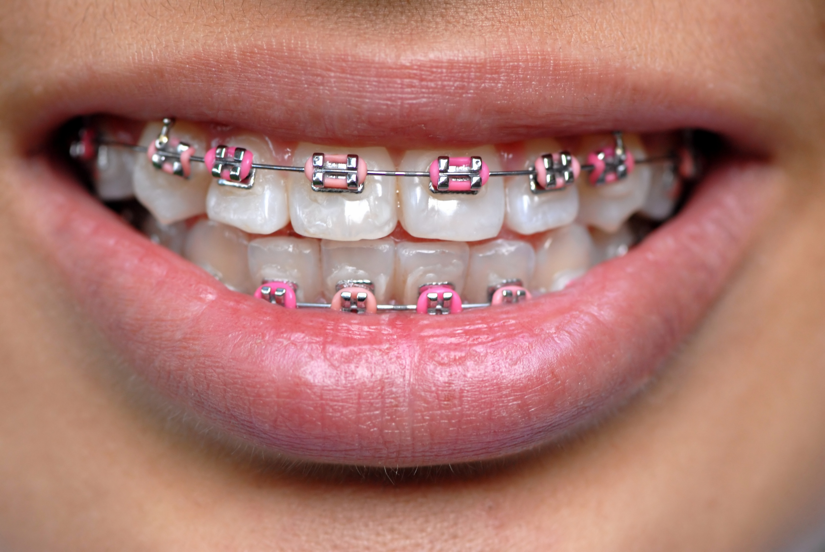 Braces Pink Bands
