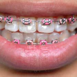 Braces Pink Bands