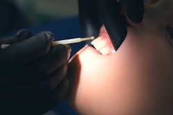 Fluoride Application Closeup