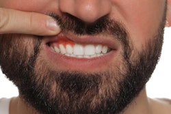 Inflamed Gums Man
