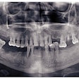 Missing Teeth Pano