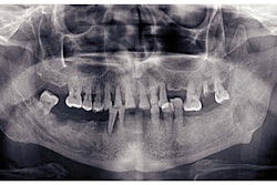 Missing Teeth Pano