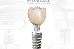The Glidewell HT implant system. Image courtesy of Glidewell Laboratories.