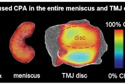 A study that came out of Clemson University's partnership with the Medical University of South Carolina and an industry collaborator sharpens the focus on the knee or the jaw's temporomandibular joint (TMJ). Image and caption courtesy of Clemson University.