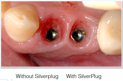 Figure 2: A side-by-side comparison of two dental implant sites without SilverPlug (left) and with SilverPlug (right).