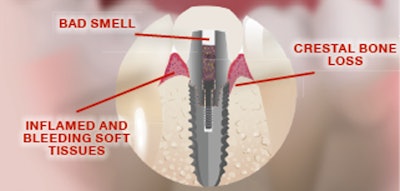 Figure 1: This figure illustrates the combined issues inherent with the typical screw channel of dental implants. Images courtesy of Larry Clark.