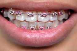 Braces Pink Bands