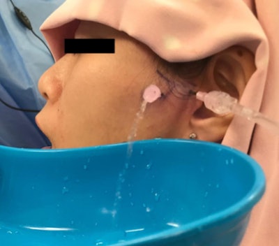 Arthrocentesis of the TMJ performed in the usual manner under local anesthesia. The puncture point of the inflow needle was at a distance of 10 mm anterior to the tragus and 2 mm inferior to the canthal-tragus line. The puncture point of the outflow needle was at a distance of 20 mm anterior to the tragus and 10 mm inferior to the canthal-tragus line. Image courtesy of Durham et al. Licensed under CC BY-NC-ND.