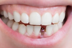 Dental Implant Single Tooth