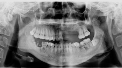 A panoramic radiograph taken during the man's first visit.