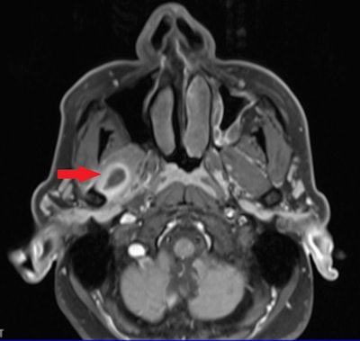 The axial section of the MRI shows a ring-enhancing lesion within the left lateral pterygoid muscle, suggestive of cysticercosis. Image courtesy of KV and colleagues. Licensed under CC BY 4.0.