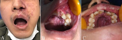 (A) An extraoral photograph (frontal view) showed multiple irregular, crusted lesions on the left face extending along the rami maxillary trigeminal nerve. (B) An intraoral photograph of the empty extraction fossa with smooth inherent alveolar bone, devoid of bleeding, and several large ulcerative surfaces in the mucosa. (C) An intraoral photograph captured swelling, congestion, and erosion in the upper left hard palate. Images and captions courtesy of Sun and colleagues. Licensed under CC BY 4.0.