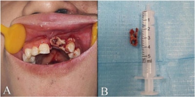(A) An intraoral photograph showed the presence of sequestrum formation in the area of the left upper anterior teeth. (B) The removed sequestrum.