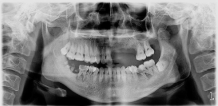 A panoramic radiograph taken during the man's first visit.