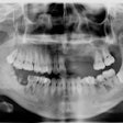 A panoramic radiograph taken during the man's first visit.