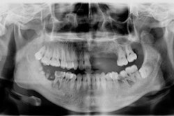 A panoramic radiograph taken during the man's first visit.