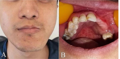 (A) An extraoral photograph showed the facial scars and hyperpigmentation had mostly subsided. (B) An intraoral photograph showed the full recovery of mucous membranes and gums.