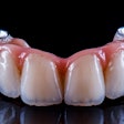 Arch Bridge Implant