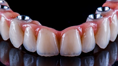 Arch Bridge Implant