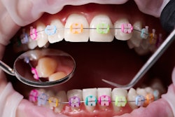 Braces Color Bands