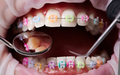 Braces Color Bands