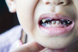 Child Caries Tooth Decay