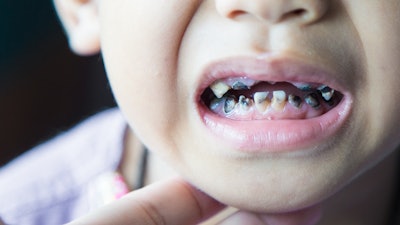 Child Caries Tooth Decay