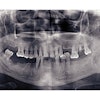 Missing Teeth Pano
