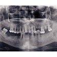 Missing Teeth Pano