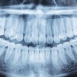 Panoramic Xray