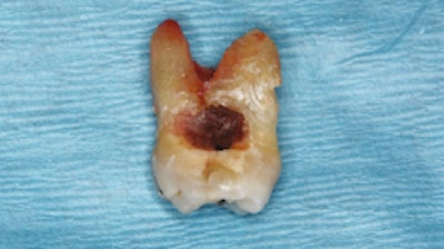 Maxillary second molar (tooth #2) showing extensive mesial surface root caries. Images courtesy of C Ehrhardt, KK Mäkinen, and CM Cobb. Licensed under a Creative Commons license.