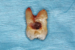 Maxillary second molar (tooth #2) showing extensive mesial surface root caries. Images courtesy of C Ehrhardt, KK M&auml;kinen, and CM Cobb. Licensed under a Creative Commons license.