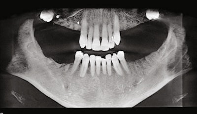 Panoramic radiograph (circa 2016) following extraction of all posterior teeth except the mandibular first bicuspids. Impacted third molars were not removed due to the distinct possibility of ankylosis and the potential for fracturing the posterior wall and floor of the maxillary antrum.