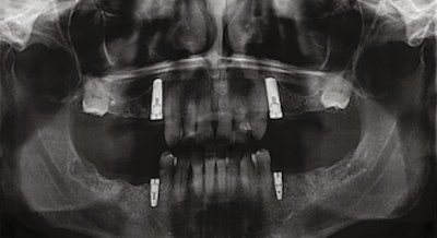 Panoramic radiograph (March 2017) after placement of dental implants and treatment planned for a shortened dental arch.