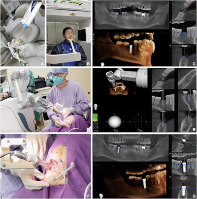 The surgical process of autonomous dental implant robotic system. (A) Positioning marker fixed to contralateral tooth of the same jaw at patient's implant site using interim crown material. (B) Preoperative CBCT examination of participant with positioning maker. (C) Treatment plan designed before surgery. (D-F) Autonomous dental implant robotic system in use. (G) Postoperative evaluation: comparing the accuracy of preoperatively planned implant position (in blue) with the actual postoperative position.