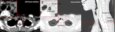 CT images of the esophageal foreign body. (A) Transverse section on the T2 level in the soft-tissue window. (B) Transverse section on the T2 level in the lung window. (C) Sagittal section of the esophagus and the foreign body in the lung window. Images and captions courtesy of Y. Pan, J. Huang, Y. Xie. Licensed under CC BY 4.0.