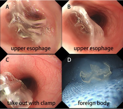 Endoscopic images. (A, B) Image of the foreign body in the woman's upper esophagus. (C) Foreign body taken out with a clamp. (D) The foreign body in vitro.