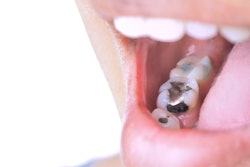 Amalgam Filling