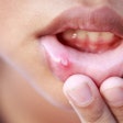 Canker Sore Skt Studio