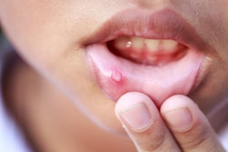 Canker Sore Skt Studio