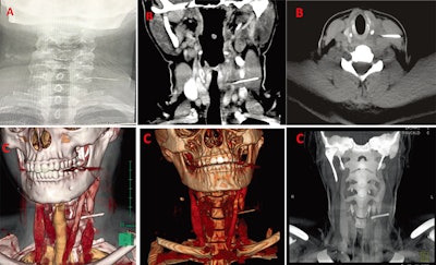 A: An x-ray showed a long, thin, and impinged foreign body. B: CT confirmed that the body was metallic and 3 cm in length. C: 3D reconstructed images were used for planning the removal of the needle. Image courtesy of Hassen Mohammed, MD, et al. Licensed under CC BY-NC 4.0.