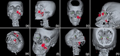 3D reconstruction (a-h) of the emphysema (red) and display of the potential pathways to the intracranial space, i.e., along the inferior orbital fissure and finally via the foramen rotundum (green) and/or via the pterygoid canal (yellow). 3D, three-dimensional. Image courtesy of Bruckmann et al. Licensed by CC BY 4.0.
