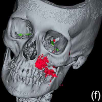 2022 05 06 Pneumocephalus Dental Polisher 400