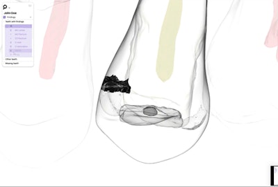 A 3D image of a tooth.