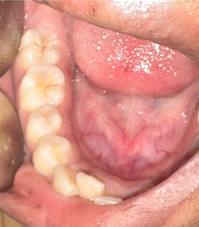 The intraoral photograph shows composite restoration of the mandibular right first molar. Images and captions courtesy of Chawla et al. Licensed under CC BY 4.0.