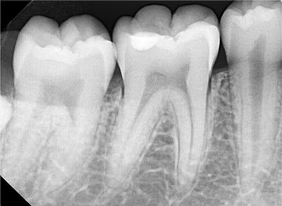 The intraoral periapical radiograph shows radiopaque restoration of the mandibular right first molar involving the enamel and the upper one-third of the dentine. The radiograph does not show any pulpal or periapical pathology.