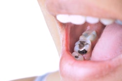 Amalgam Filling