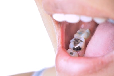 Amalgam Filling